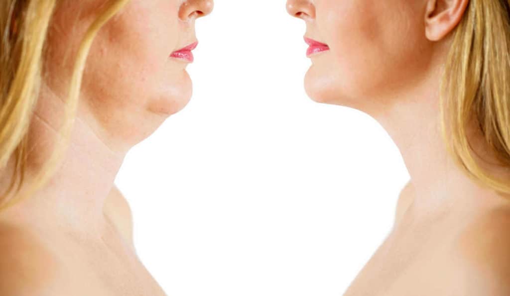 Double Chin treatment St Helens before and after results
