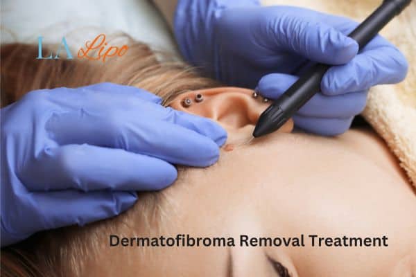 Dermatofibroma Removal Treatment St Helens