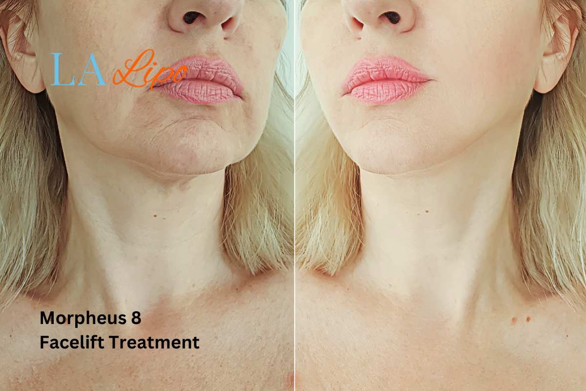 Turn back time with Morpheus8 Treatment St Helens