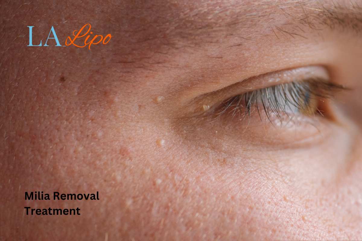 Cryopen Milia Removal: Is It the Easiest and Safest Option St Helens?