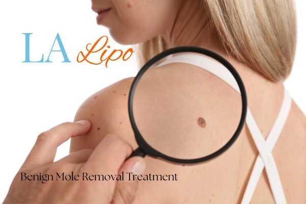 Woman having her inspection of blemish before mole removal St Helens