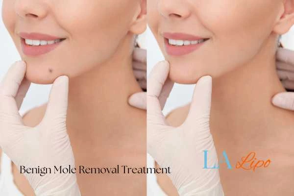 Before and after mole removal St Helens treatment