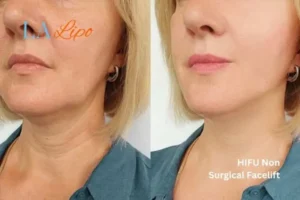 hi-fu for wrinkles St Helens before and after results