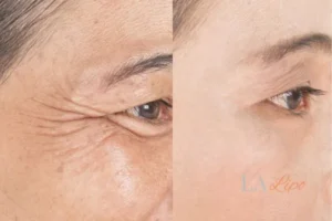 Before and after results of woman - HI-fu wrinkles reduction treatment St Helens