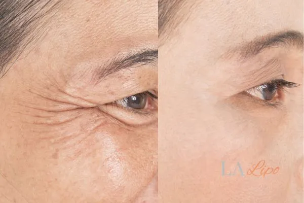 Before and after results of woman - HI-fu wrinkles reduction treatment St Helens