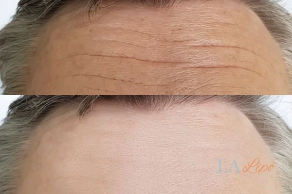 results of HIFU St Helens on mans forehead to help reduce lines and wrinkles