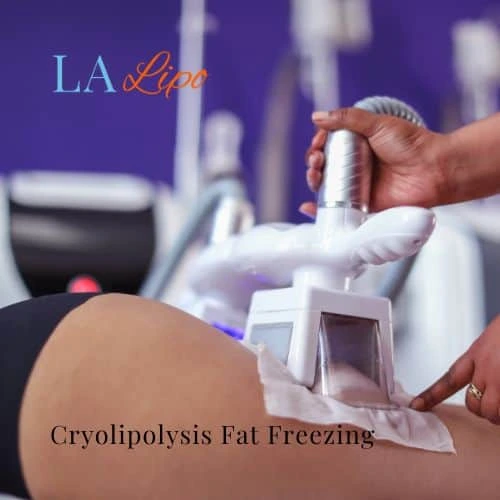 fat freezing - Cryolipolysis St Helens