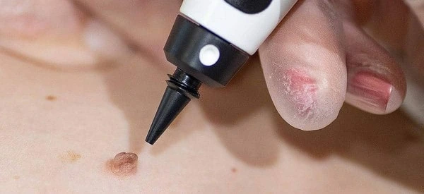 skin tag removal using cryopen St Helens