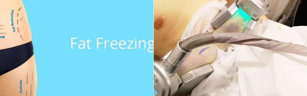 multi areas of a persons body having coolsculpting St Helens treatment