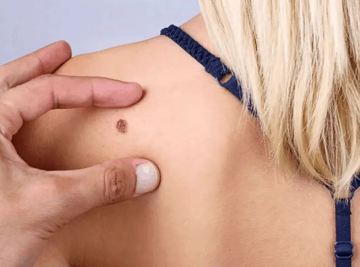woman having mole removal St Helens consultation before treatment.