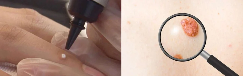 Person getting moles removed with cryopen St Helens