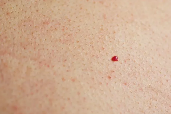 close up of a cherry angioma St Helens