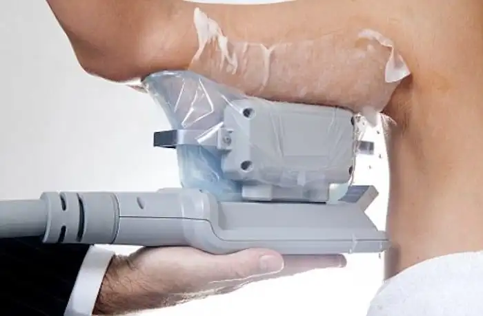 Picture of fat freezing St Helens on the upper arms.