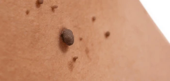 image of a skin tag St Helens