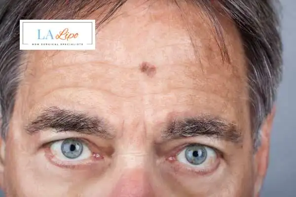 Solar Lentigo Removal St Helens image of man with mark on his forehead