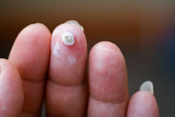 wart on person finger - cryotherapy to treat from LA LIPO St Helens