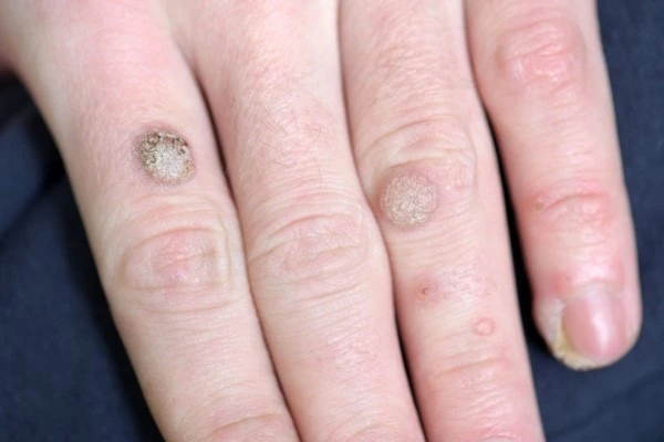 photo of warts on person hand - see wart removal St Helens from LA LIPO