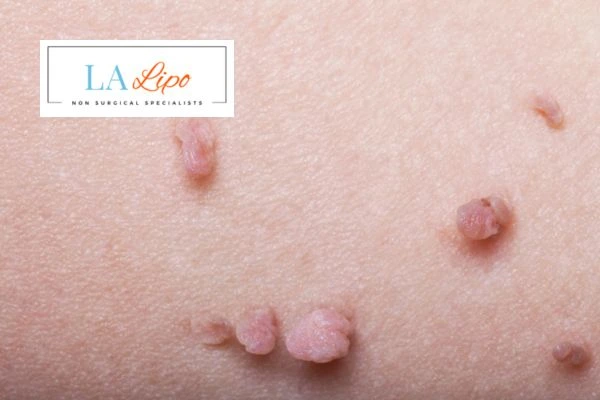 Does cryopen skin tag removal St Helens hurt? Find out now call our team today!