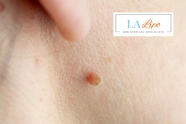 Book skin tag removal St Helens today speak to our team now!