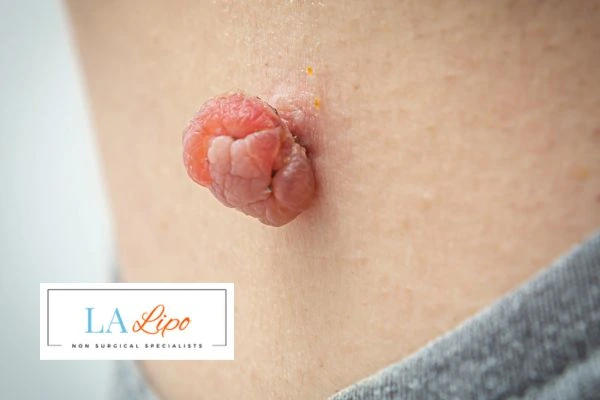 Interested in skin tag removal St Helens? Concerned about the pain? Find out more today!