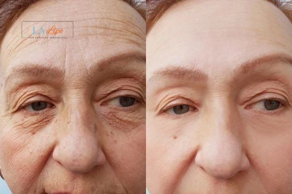 The powerful benefits of Morpheus8 Treatment St Helens - Call Our team today!