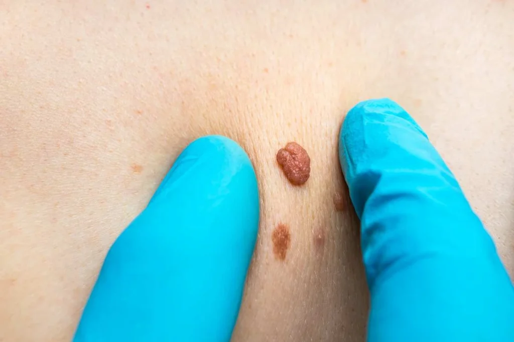 LA LIPO Cryopen Lesion Removal Prices St Helens