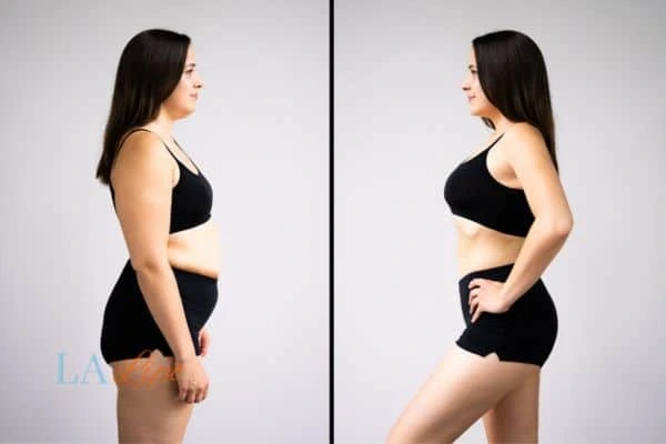 Picture of womans before and after using LA-EMS body sculpting to improve her core strength St Helens