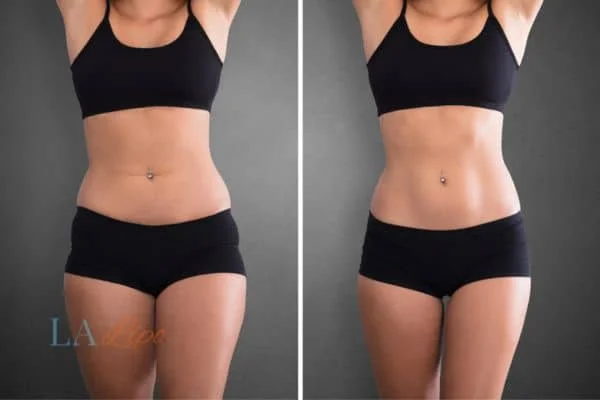 before and after results of non-surgical treatment to help a woman's body image and mental health St Helens