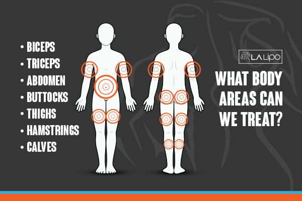 Diagram to show areas you can have LA-EMS Body Sculpting Treatment St Helens