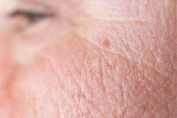 close up picture of a woman's face showing an age spot St Helens