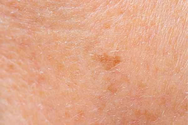 close up picture of age spots St Helens