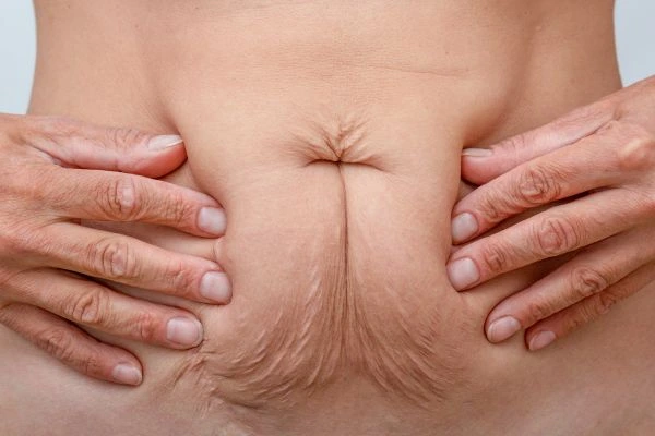 Image of a woman's stomach with loose skin - example of skin tightening St Helens options