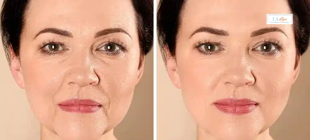 How Long Does It Take to See Results and How Long Do They Last St Helens?