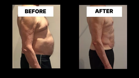 What Symptoms Can Diastasis Recti Cause in Men? Weak Core, Back Pain and Poor Posture St Helens